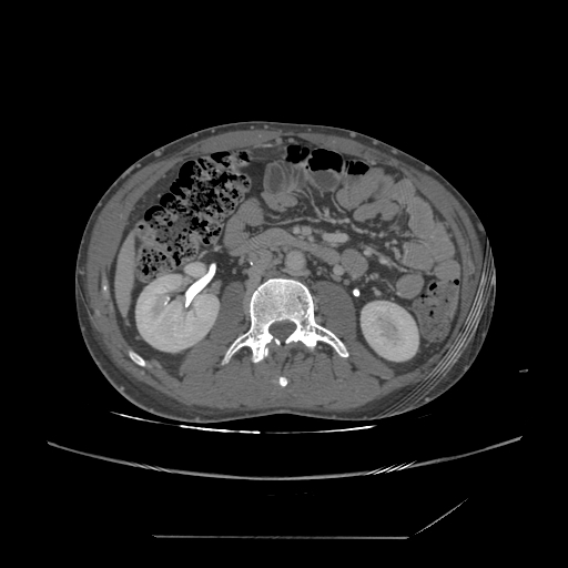 File:Chronic IVC thrombosis and resultant IVC filter malposition (Radiopaedia 81158-94800 A 100).jpg