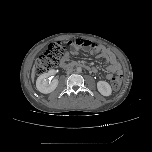 File:Chronic IVC thrombosis and resultant IVC filter malposition (Radiopaedia 81158-94800 A 102).jpg