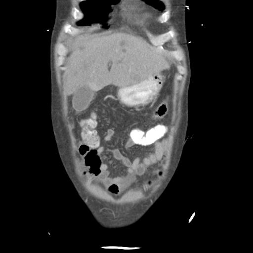 Chronic diverticulitis complicated by hepatic abscess and portal vein thrombosis (Radiopaedia 30301-30938 B 14).jpg