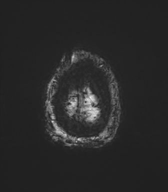 Chronic hypertensive encephalopathy (Radiopaedia 72844-83495 Axial SWI magnitude 83).png