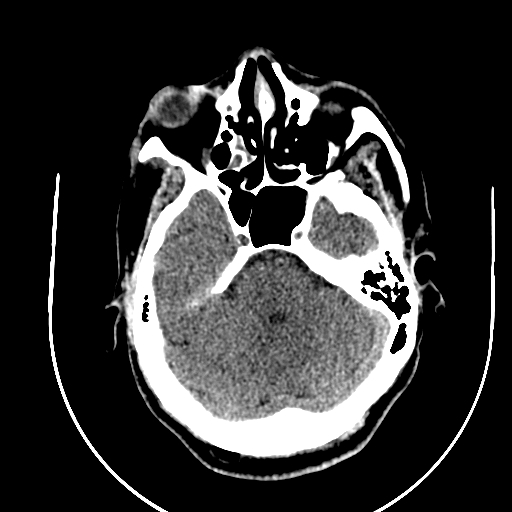 Chronic invasive fungal sinusitis (Radiopaedia 91563-109286 Axial non-contrast 26).jpg
