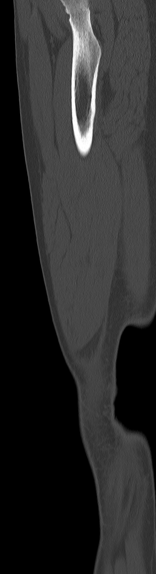 Chronic ostemyelitis of the femur with long sinus tract (Radiopaedia 74947-85982 Sagittal bone window 30).jpg