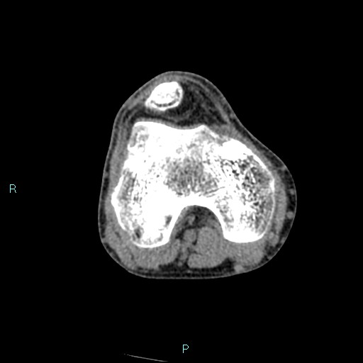 Chronic osteomyelitis (with Brodie abscess) (Radiopaedia 76405-88111 A 134).jpg