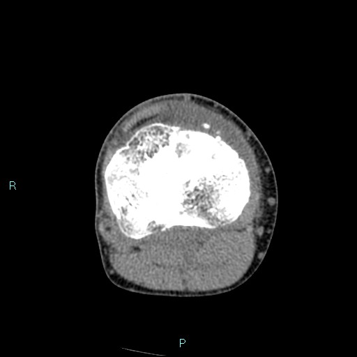 Chronic osteomyelitis (with Brodie abscess) (Radiopaedia 76405-88111 A 96).jpg
