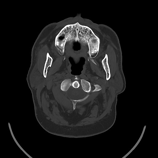 Chronic osteomyelitis - calvarial (severe) (Radiopaedia 69668-79616 Axial bone window 19).jpg