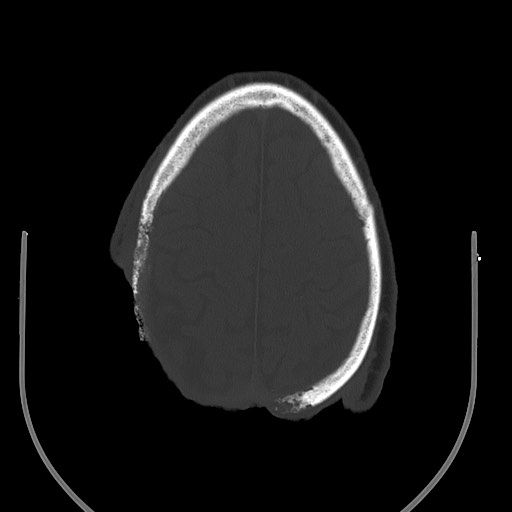 Chronic osteomyelitis - calvarial (severe) (Radiopaedia 69668-79616 Axial bone window 61).jpg