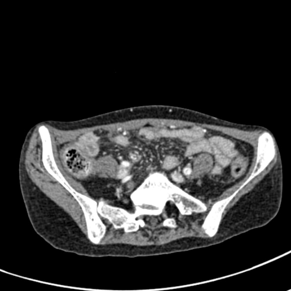 Chronic pancreatitis (Radiopaedia 55405-61846 A 76).jpg