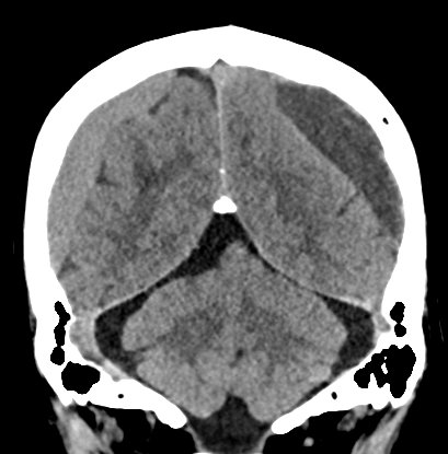 Chronic subdural hematomas (Radiopaedia 66577-75885 Coronal non-contrast 46).jpg