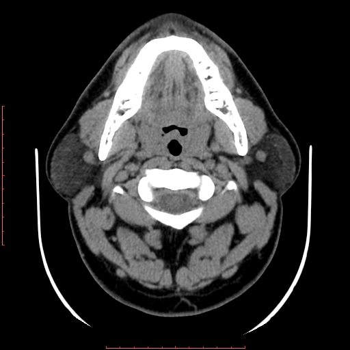 File:Chronic submandibular sialolithiasis (Radiopaedia 69817-79814 Axial non-contrast 77).jpg