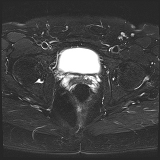 File:Class II Mullerian duct anomaly- unicornuate uterus with rudimentary horn and non-communicating cavity (Radiopaedia 39441-41755 Axial T2 fat sat 22).jpg