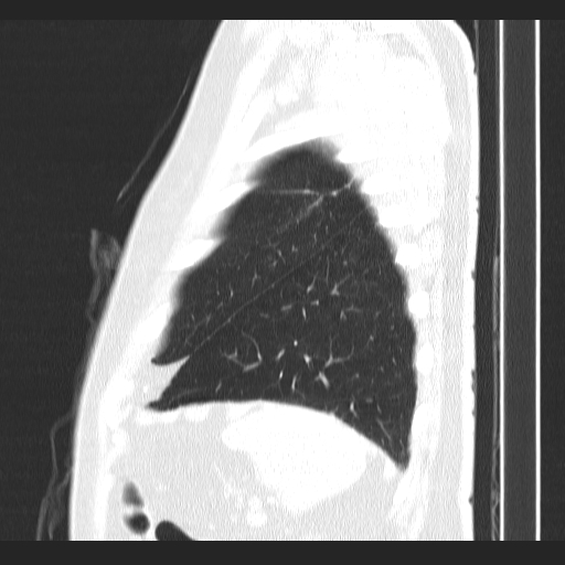 File:Classic complicated silicosis (Radiopaedia 49720-54961 Sagittal lung window 9).jpg