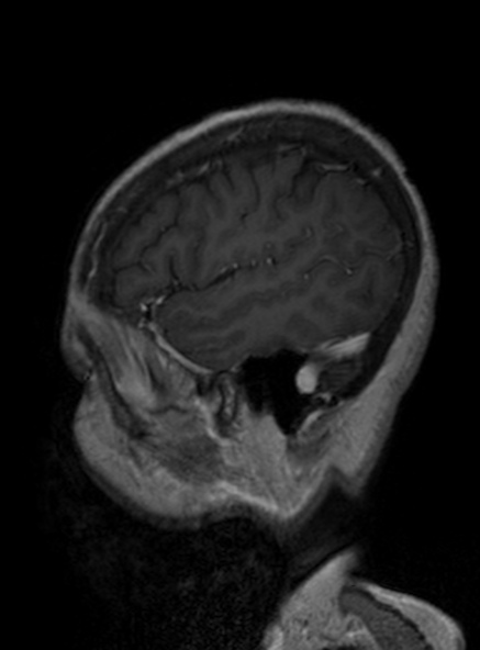 Clival meningioma (Radiopaedia 53278-59248 Sagittal T1 C+ 350).jpg