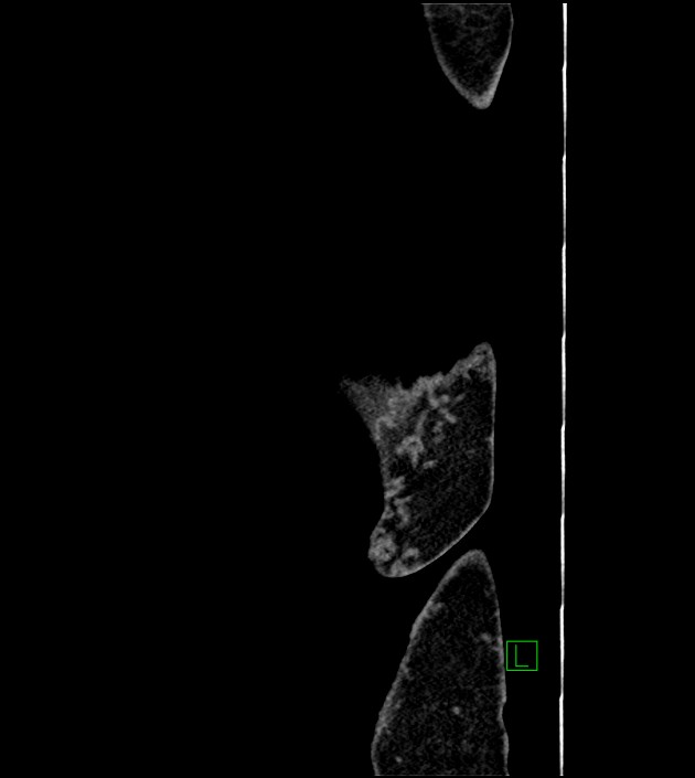 Closed-loop small bowel obstruction-internal hernia (Radiopaedia 78439-91096 C 3).jpg