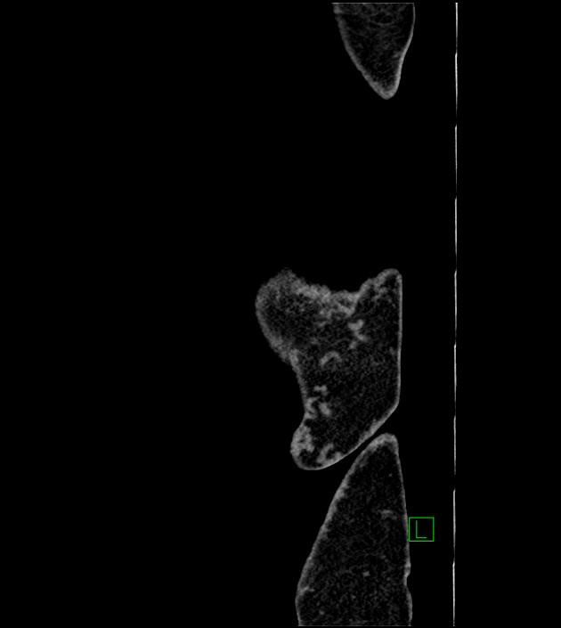 Closed-loop small bowel obstruction-internal hernia (Radiopaedia 78439-91096 C 4).jpg