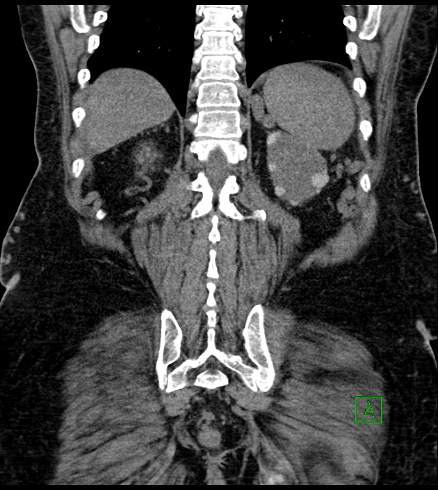 Closed-loop small bowel obstruction-internal hernia (Radiopaedia 78439-91096 Coronal non-contrast 80).jpg