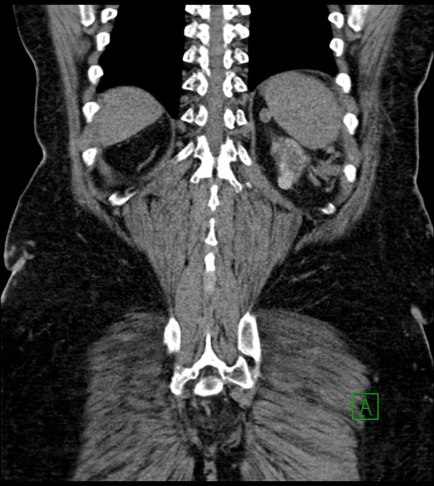 Closed-loop small bowel obstruction-internal hernia (Radiopaedia 78439-91096 Coronal non-contrast 84).jpg