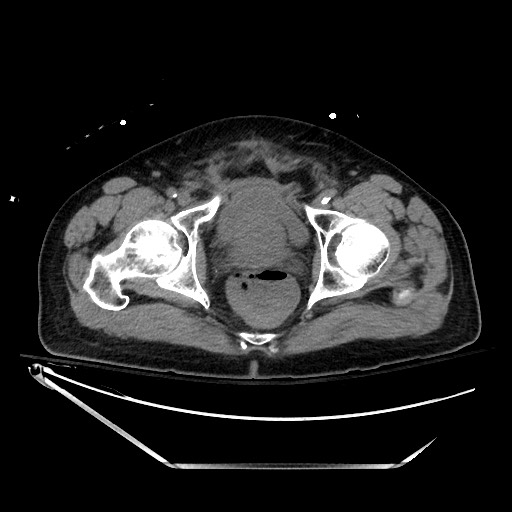 File:Closed loop obstruction due to adhesive band, resulting in small bowel ischemia and resection (Radiopaedia 83835-99023 Axial non-contrast 146).jpg