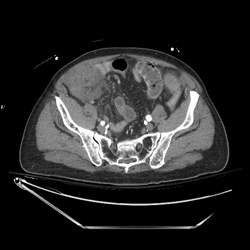 Closed loop obstruction due to adhesive band, resulting in small bowel ischemia and resection (Radiopaedia 83835-99023 B 117).jpg