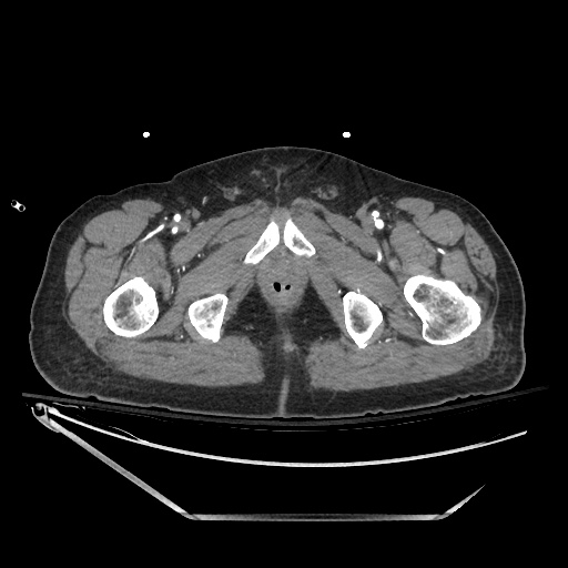 File:Closed loop obstruction due to adhesive band, resulting in small bowel ischemia and resection (Radiopaedia 83835-99023 B 161).jpg