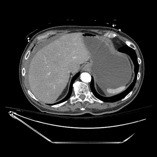 File:Closed loop obstruction due to adhesive band, resulting in small bowel ischemia and resection (Radiopaedia 83835-99023 B 30).jpg