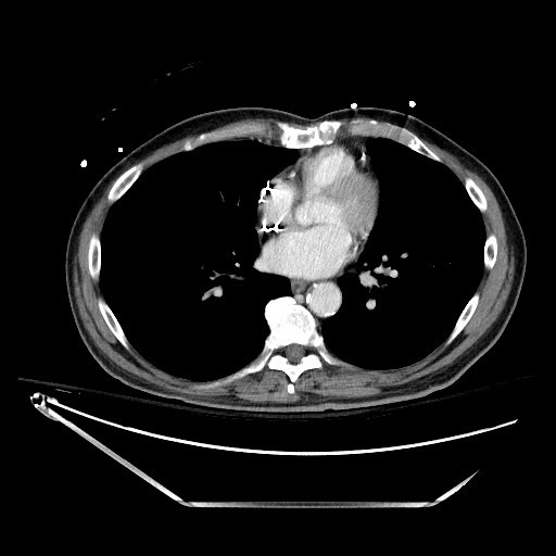 File:Closed loop obstruction due to adhesive band, resulting in small bowel ischemia and resection (Radiopaedia 83835-99023 D 3).jpg