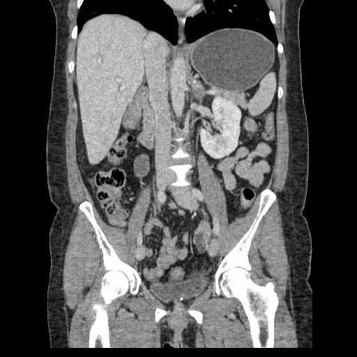 File:Closed loop small bowel obstruction (Radiopaedia 65403-74451 B 59).jpg