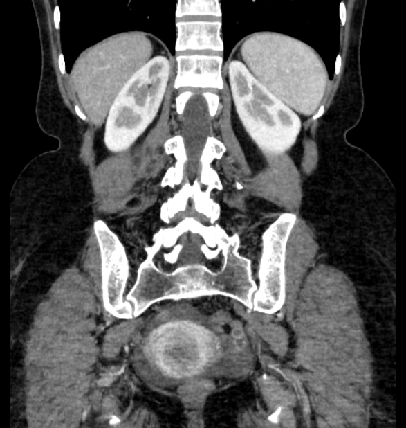 Closed loop small bowel obstruction (Radiopaedia 71211-81508 B 99).jpg