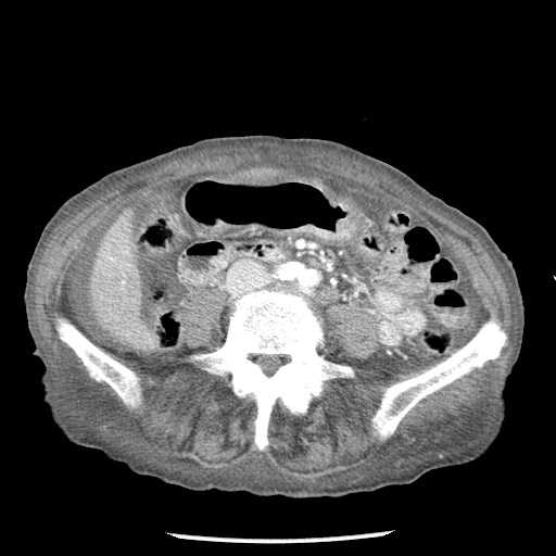 Closed loop small bowel obstruction - adhesions and infarct (Radiopaedia 85125-100678 B 55).jpg