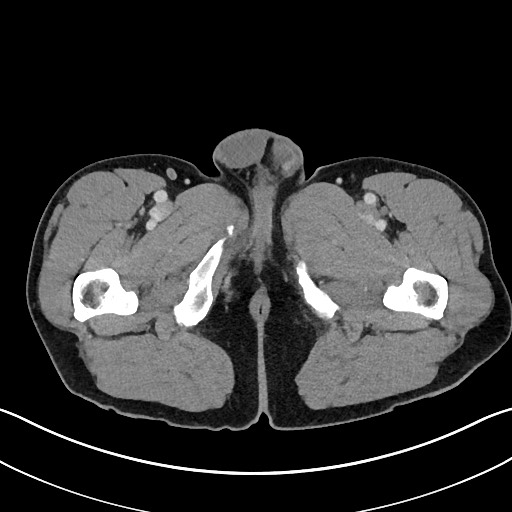 Closed loop small bowel obstruction - internal hernia (Radiopaedia 57806-64778 B 143).jpg