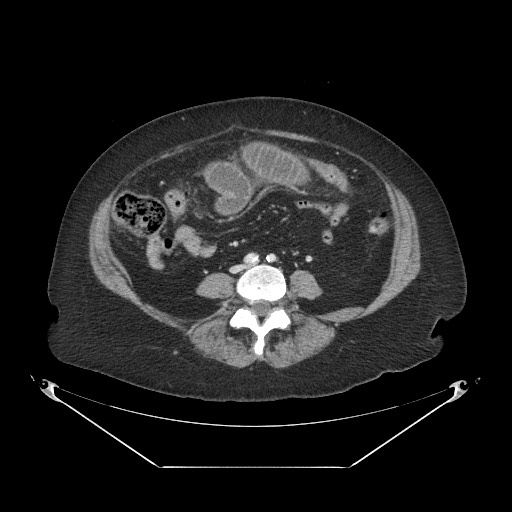 Closed loop small bowel obstruction - internal hernia (Radiopaedia 65402-74450 A 78).jpg