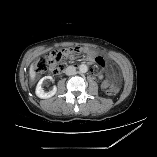 Closed loop small bowel obstruction - omental adhesion causing "internal hernia" (Radiopaedia 85129-100682 A 79).jpg
