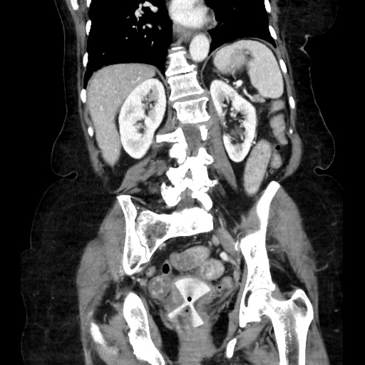 File:Closed loop small bowel obstruction due to adhesive band, with intramural hemorrhage and ischemia (Radiopaedia 83831-99017 C 83).jpg