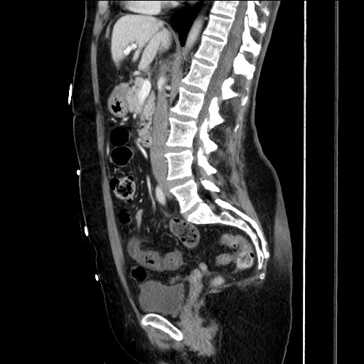 File:Closed loop small bowel obstruction due to adhesive bands - early and late images (Radiopaedia 83830-99014 C 89).jpg