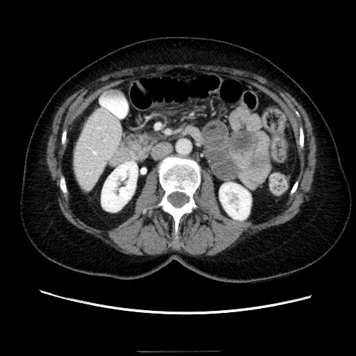 Closed loop small bowel obstruction due to adhesive bands - early and late images (Radiopaedia 83830-99015 A 67).jpg