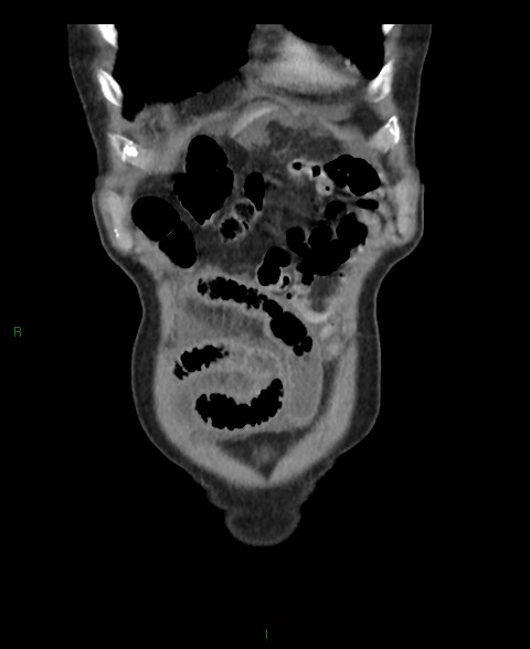 Closed loop small bowel obstruction with ischemia (Radiopaedia 84180-99456 B 59).jpg