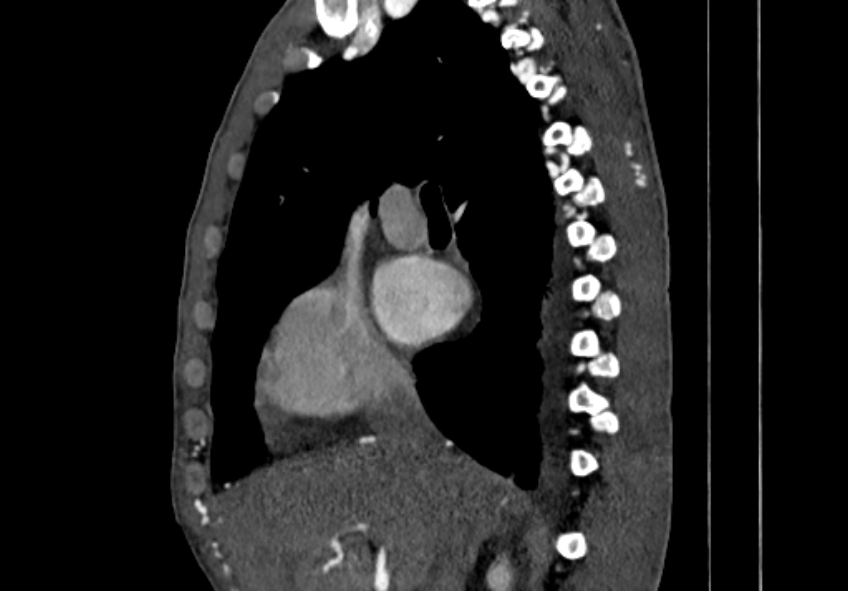 Coarctation of aorta with aortic valve stenosis (Radiopaedia 70463-80574 B 11).jpg