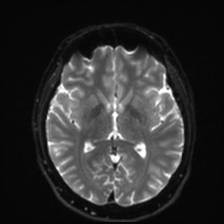Cochlear incomplete partition type III associated with hypothalamic hamartoma (Radiopaedia 88756-105498 Axial DWI 21).jpg