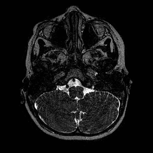 File:Cochlear nerve aplasia - unilateral (Radiopaedia 87910-104413 Axial T2 4).jpg