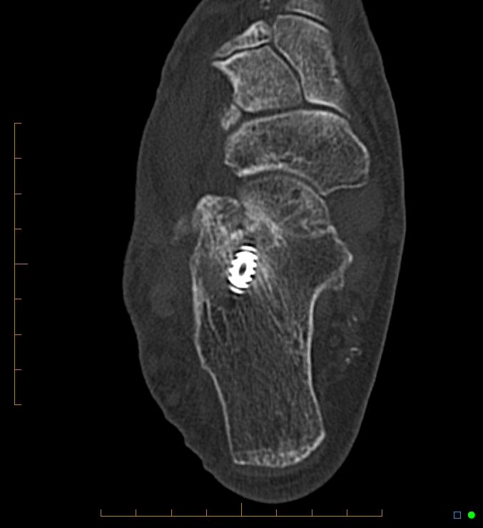 Collapsed total ankle replacement (Radiopaedia 17228-16932 Axial bone window 54).jpg