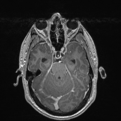 File:Colloid cyst (Radiopaedia 44510-48181 Axial T1 C+ 67).png