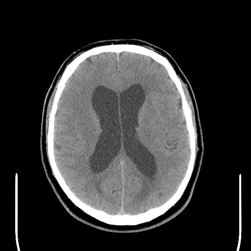 File:Colloid cyst (large) (Radiopaedia 34415-35734 Axial non-contrast 34).png
