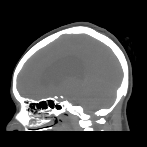 File:Colloid cyst (resulting in death) (Radiopaedia 33423-34499 B 25).png