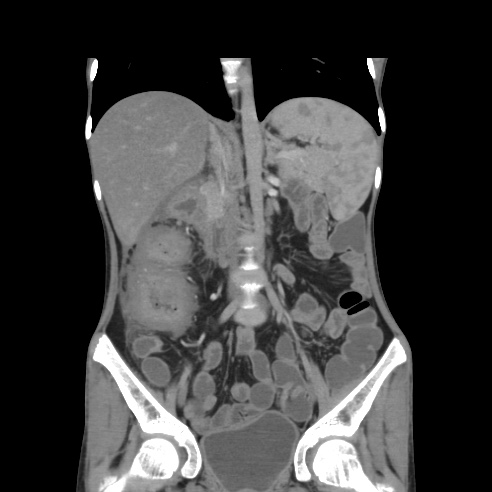 File:Colocolic fistula - Crohn disease (Radiopaedia 57063-63955 B 22).jpg