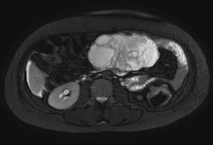 Colon adenocarcinoma with Krukenberg tumors, advanced pregnancy (Radiopaedia 67279-76645 Axial T2 SPAIR 45).jpg
