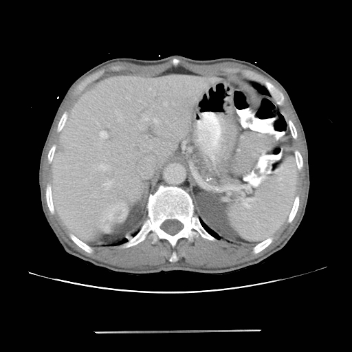 File:Colon cancer with calcified liver metastasis (Radiopaedia 74423-85307 A 18).jpg
