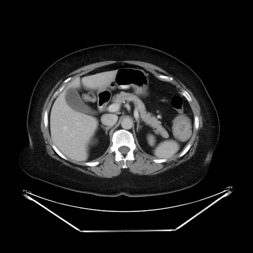 File:Colonic intussusception due to adenocarcinoma (Radiopaedia 86828-102987 A 46).jpg