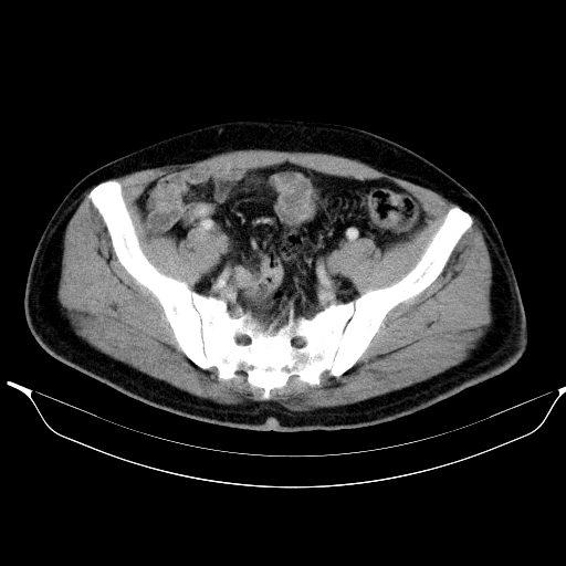 Colonic lipoma with colo-colic intussusception (Radiopaedia 58944-66200 A 53).jpg