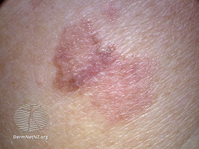 File:Macro image of amelanotic melanoma 6 (DermNet NZ amelanotic-melanoma5-macro).jpg