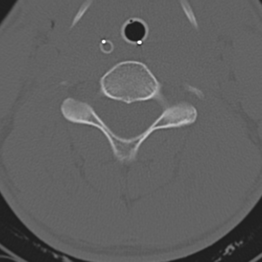 File:Multitrauma with diffuse axonal injury, temporal bone fractures and traumatic caroticocavernous fistula (Radiopaedia 37242-39035 Axial 177).png