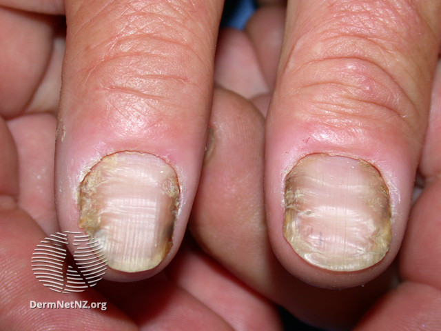 File:Nail dystrophy (DermNet NZ fungal-paron5).jpg